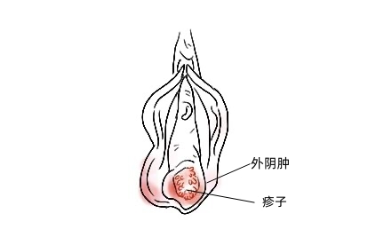 女性外阴肿珍珠图