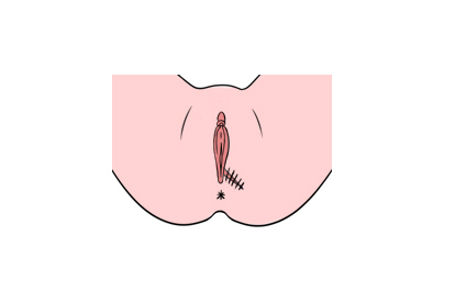 外阴缝合图片